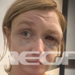 «Τον αγαπώ», σοκάρει η εικόνα και η αντίδραση της 40χρονης στο Κορωπί μετά τον ξυλοδαρμό της