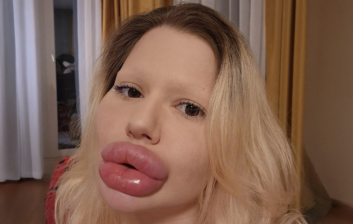 Έτσι ήταν πριν από τις πλαστικές η γυναίκα με τα «μεγαλύτερα χείλη στον κόσμο»