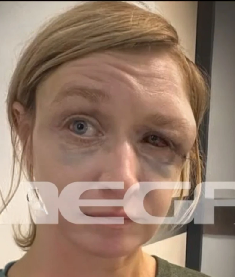 «Τον αγαπώ», σοκάρει η εικόνα και η αντίδραση της 40χρονης στο Κορωπί μετά τον ξυλοδαρμό της